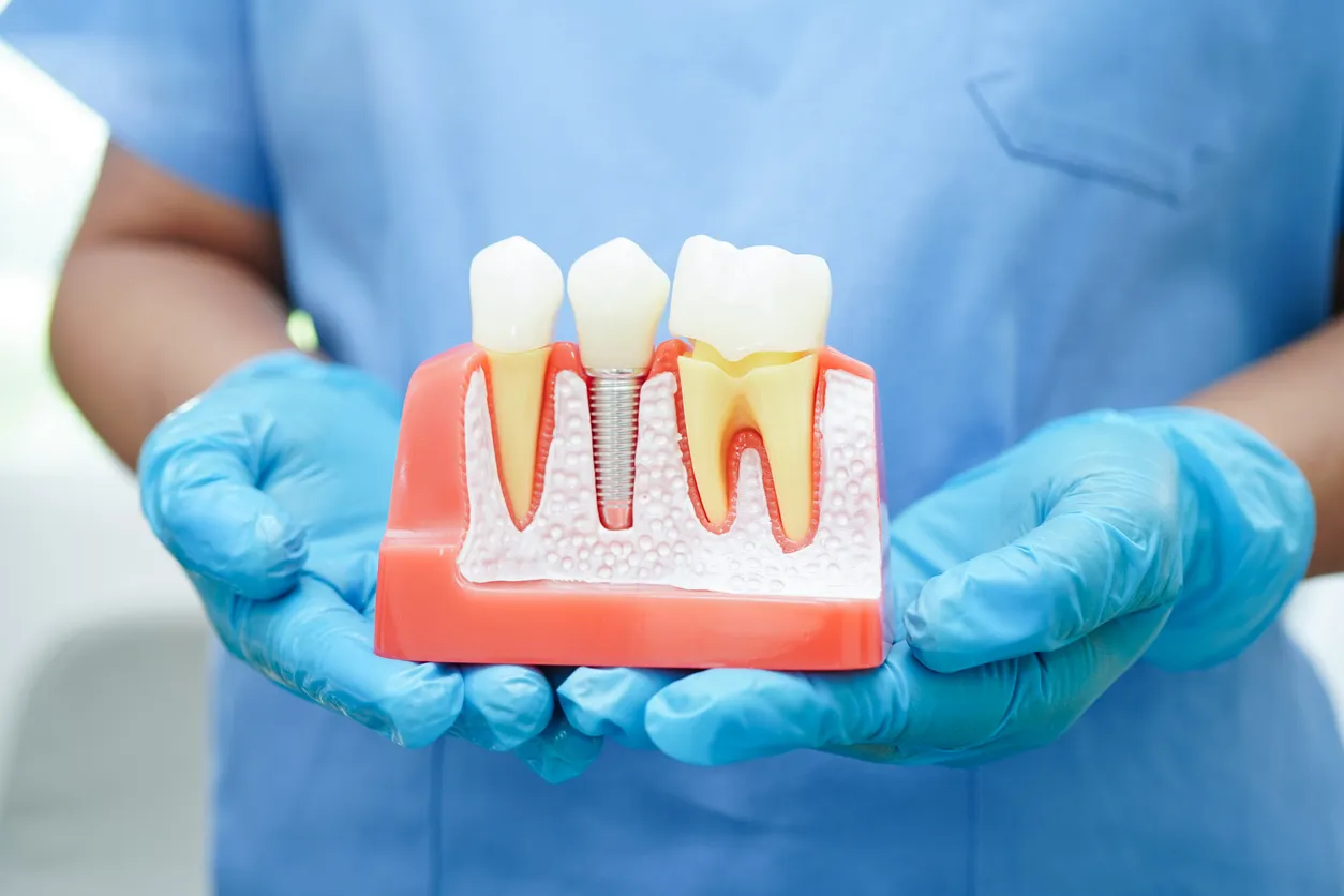 implant dentaire