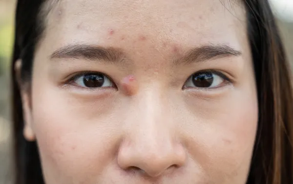 kyste ou tumeur sur le visage.jpg